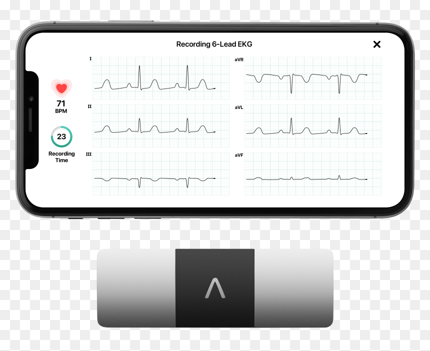 Alivecor Kardiamobile 6l Personal Ekg Monitor, HD Png Download - ekg png