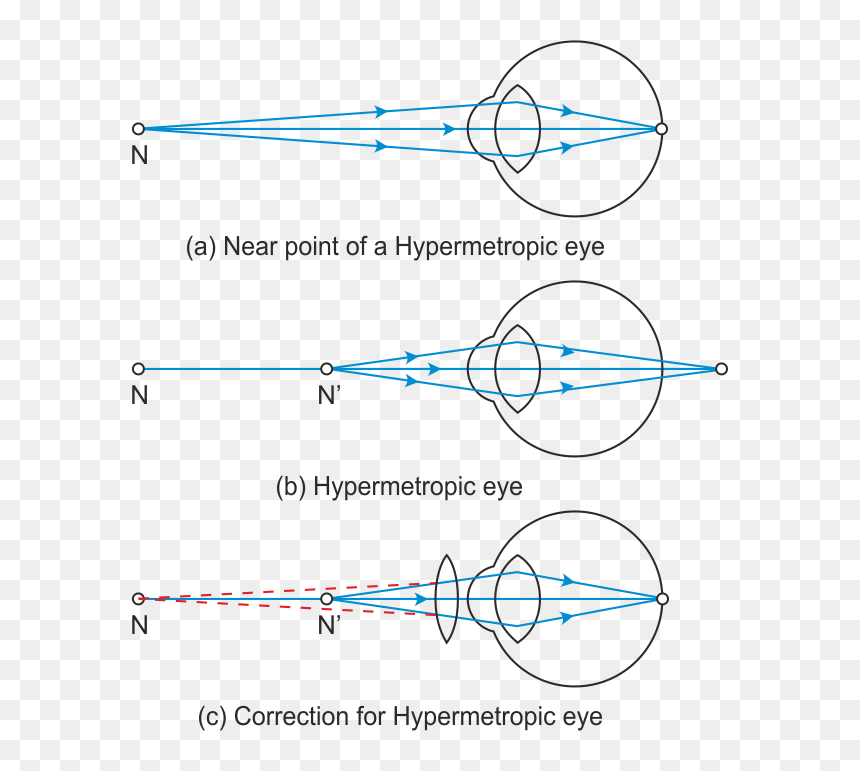 Presbyopia Diagram, HD Png Download - eye lense png