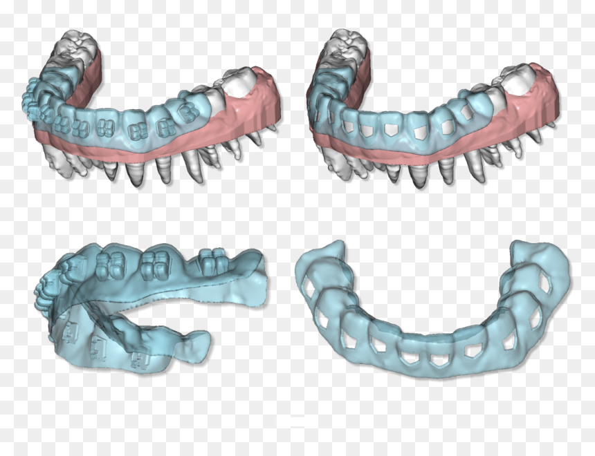 Clear Aligner Maestro 4, HD Png Download - brackets png