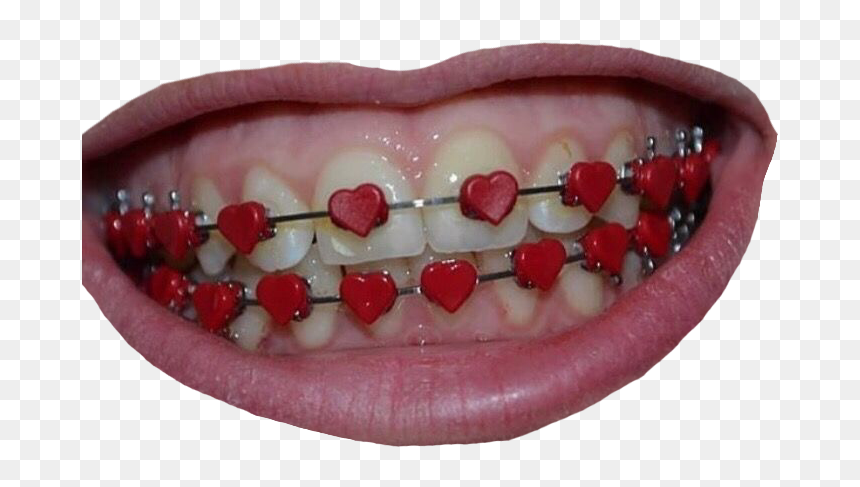 Aesthetic Braces, HD Png Download - braces png