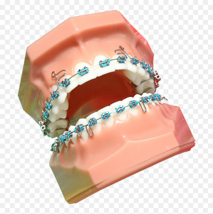 Transparent Braces Png - Rodzaje Aparatów Ortodontycznych Stałych, Png Download - braces png