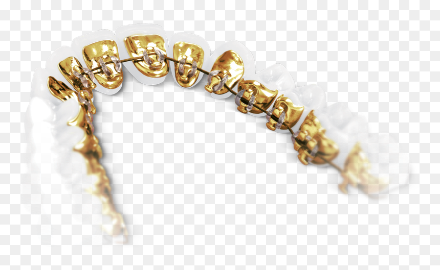 Lingual Braces Sydney - Incognito Lingual Braces, HD Png Download - braces png