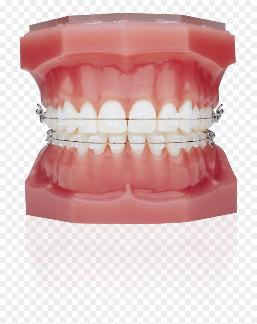 Ceramic Braces Vs Invisalign , Png Download - Ceramic Braces With Bands, Transparent Png - braces png