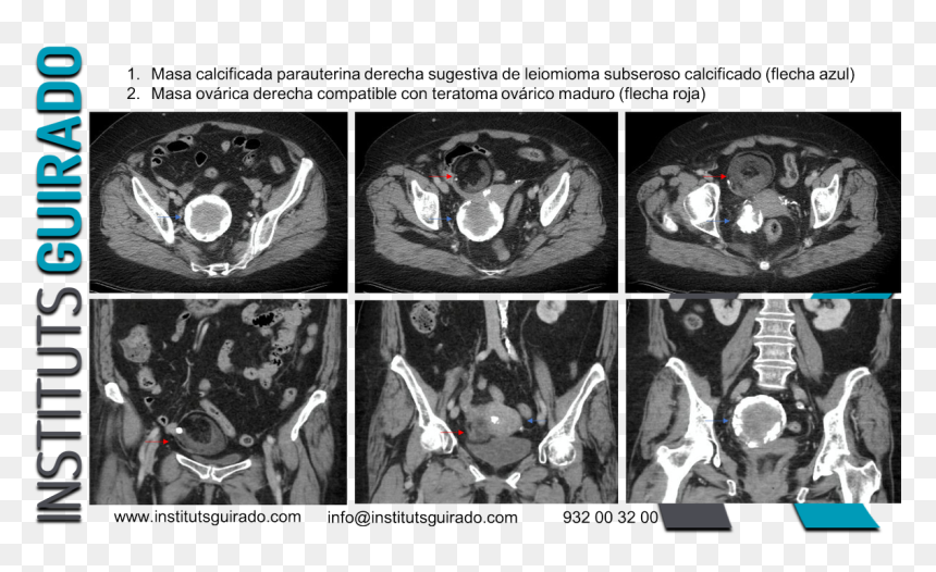 Computed Tomography, HD Png Download - flecha roja png