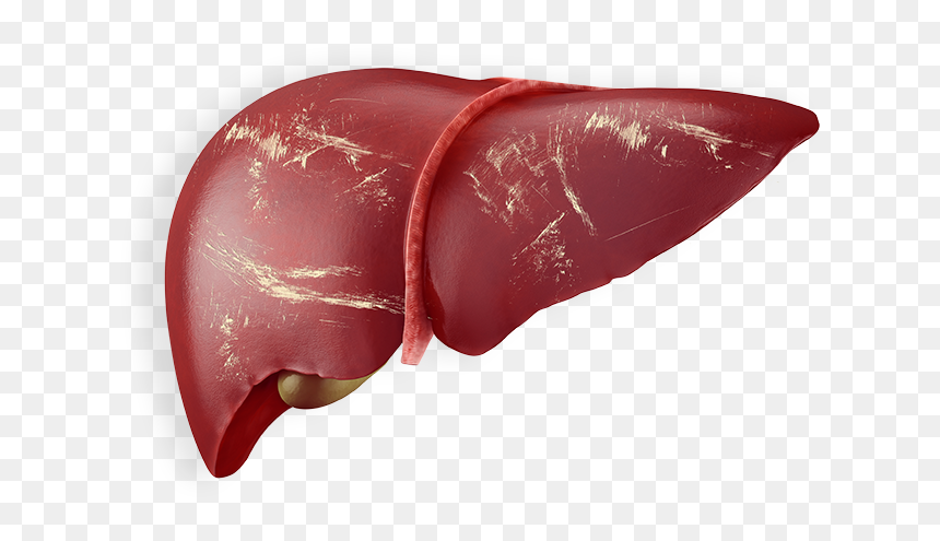 Liver Png Page - Chronic Liver With Hepatitis B, Transparent Png - liver png