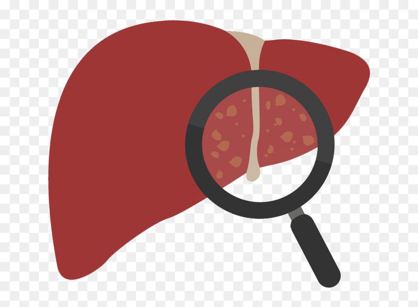 Gallstones In The Liver Clipart , Png Download - Gall Bladder Transparent Clipart, Png Download - liver png