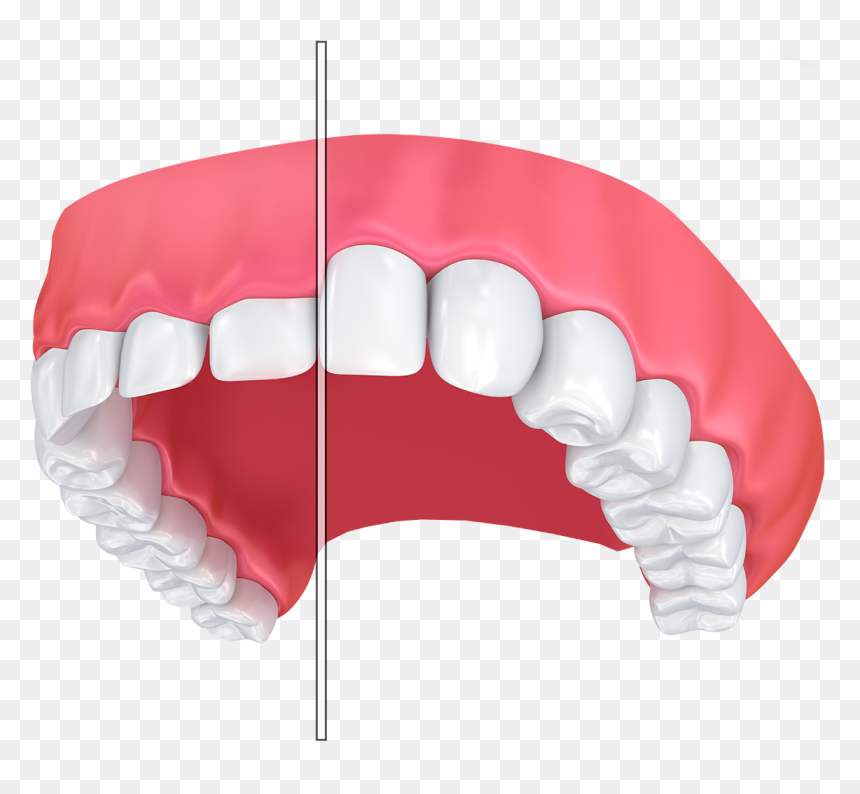 Teeth Before And After Gum Contouring - Gummy Smile Vector, HD Png Download - buck teeth png