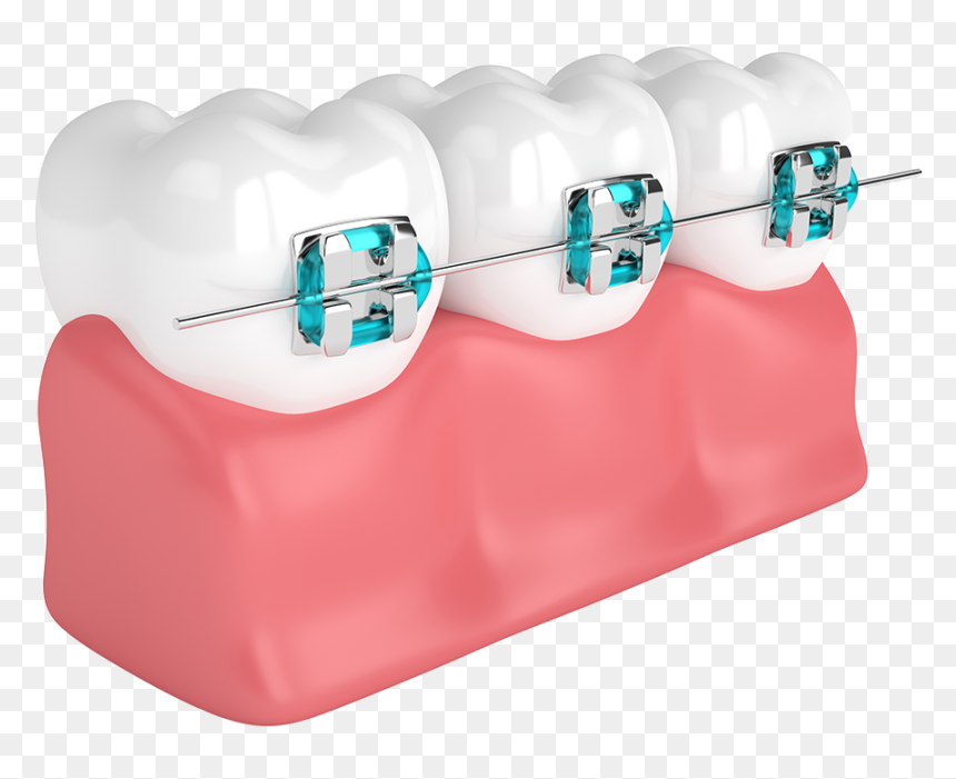 Rayos X De Dientes Brakets, HD Png Download - buck teeth png
