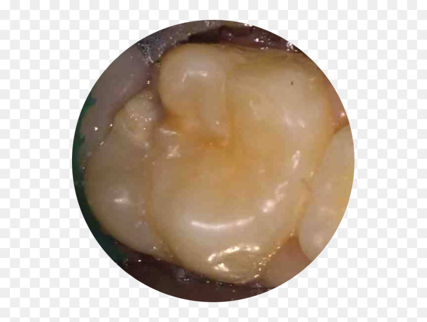 White Fillings - Before, HD Png Download - buck teeth png