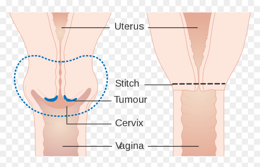 Trachelectomy 中文, HD Png Download - vagina png