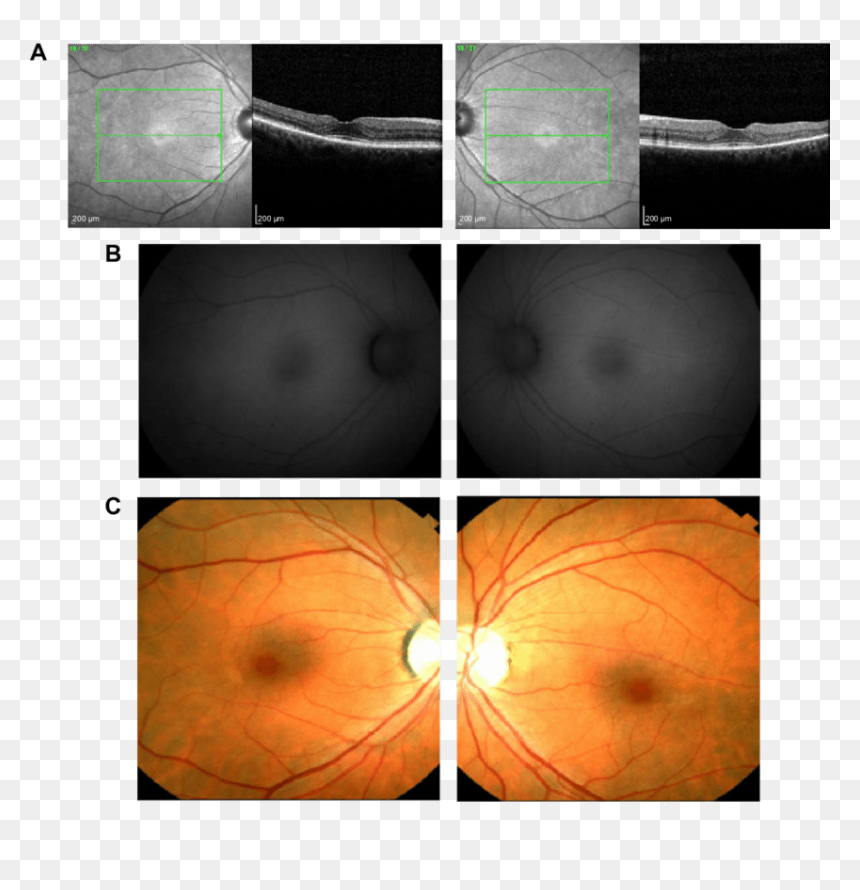 Bull"s Eye Maculopathy Visible On Near-infrared Reflectance - Bull's Eye Maculopathy Hcq, HD Png Download - bulls eye png