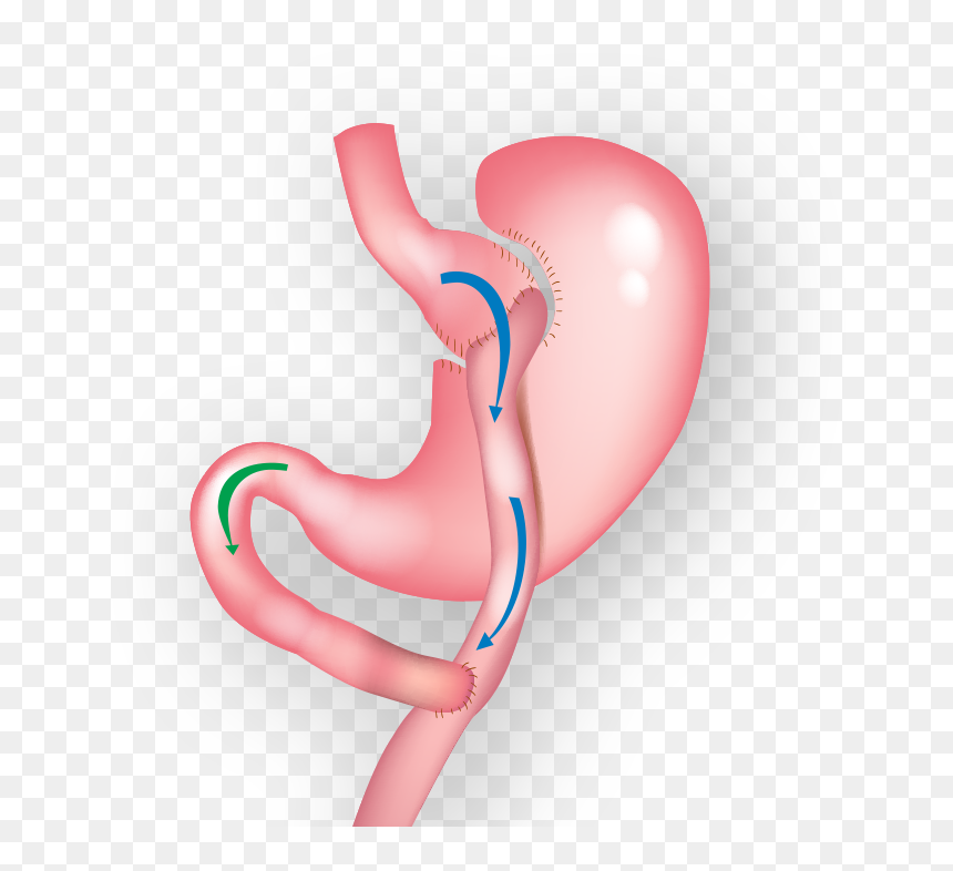 Demonstration Of Gastric Bypass Surgery Clipart , Png - Gastric Bypass Surgery, Transparent Png - stomach png