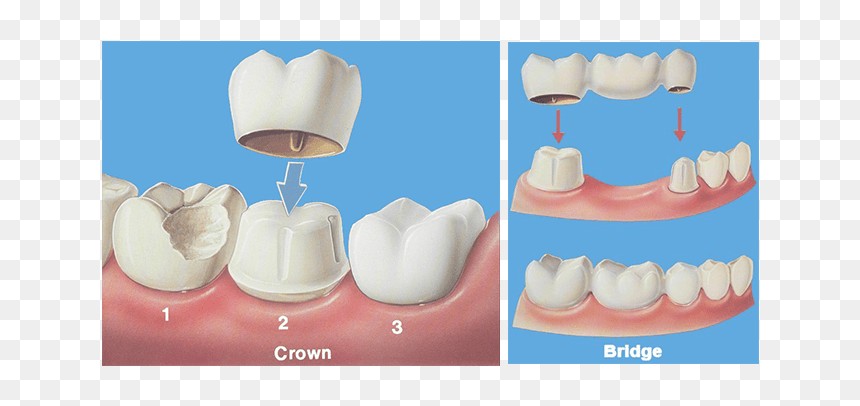 Crown Bridge Hobe Sound Dentist - Dental Crown And Bridge, HD Png Download - dentist png