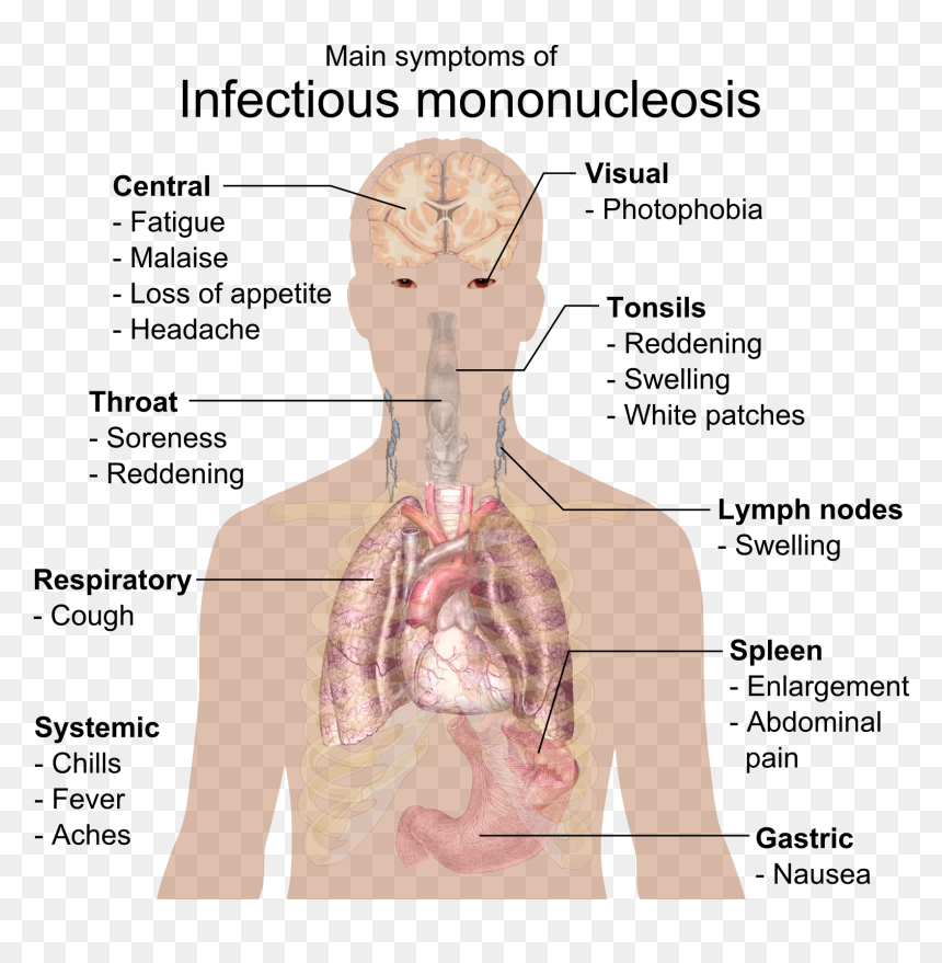 Infectious Mononucleosis, HD Png Download - best png effects