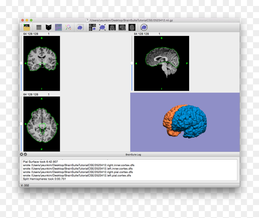 Final Output Of Cse, With Cross-hairs Off And Volume - Illustration, HD Png Download - cross hairs png