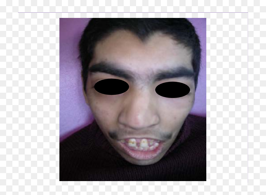 Patient"s Facial Features, Which Include Arched Eyebrows - Face Mask, HD Png Download - unibrow png