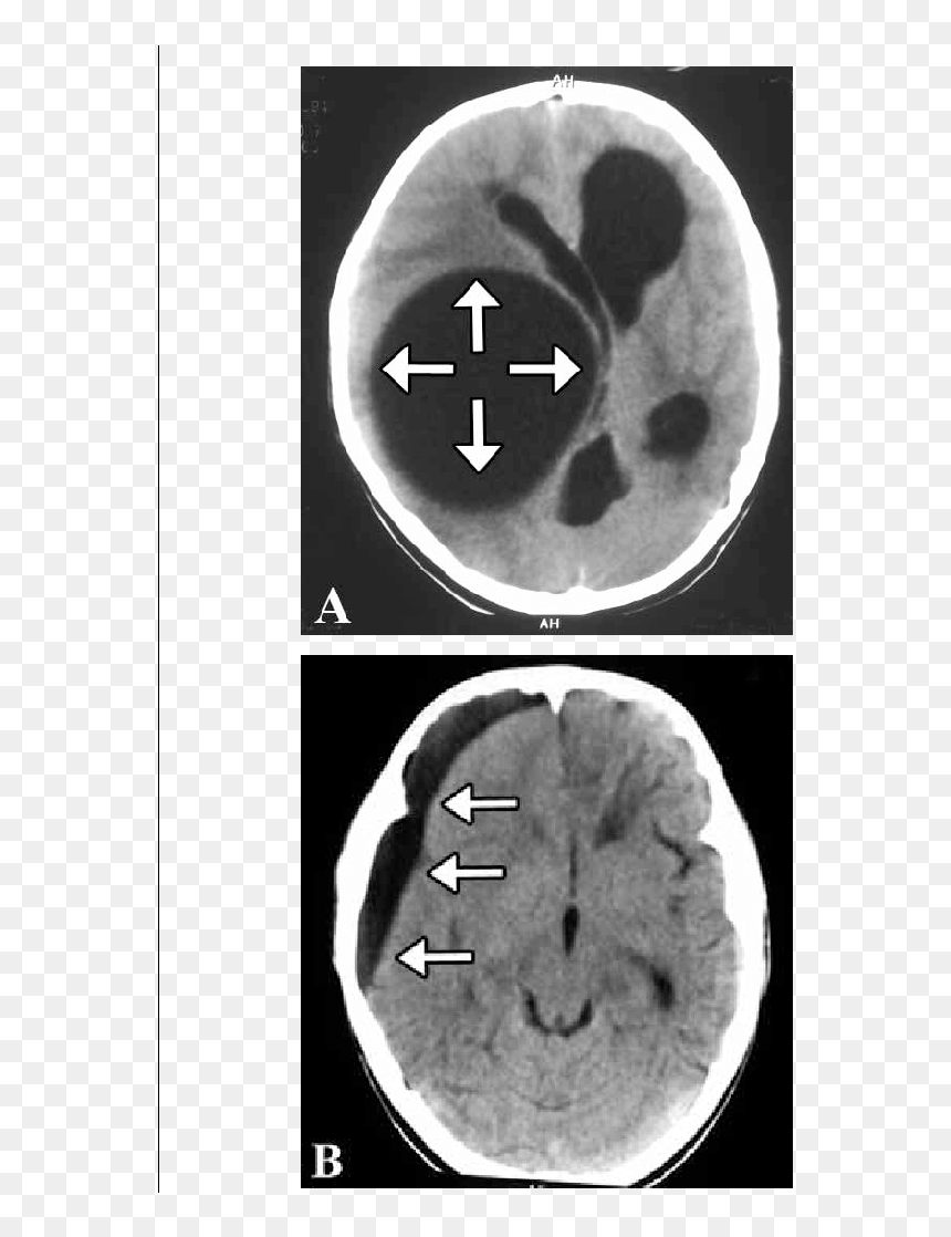 Computed Tomography, HD Png Download - brain outline png