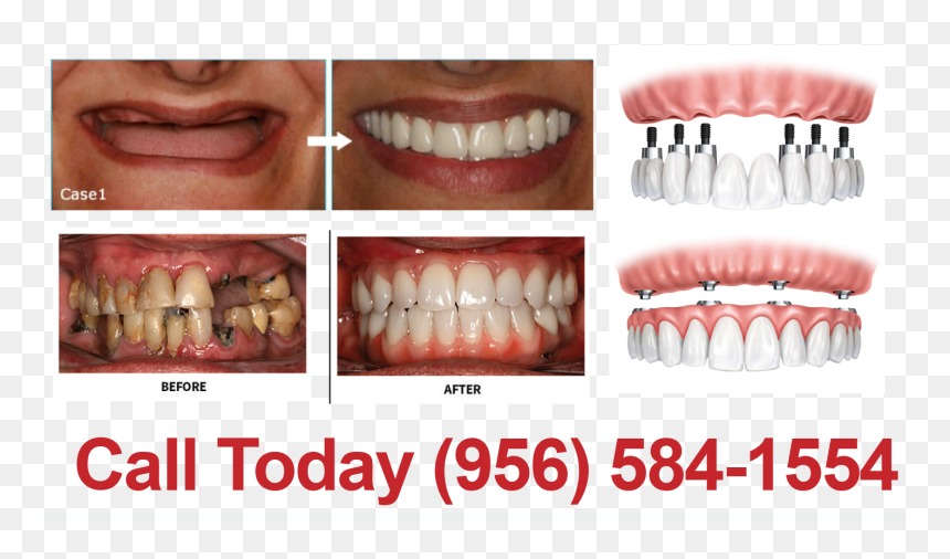 New Smile In 1 Day - Implantes Passo A Passo, HD Png Download - dental png