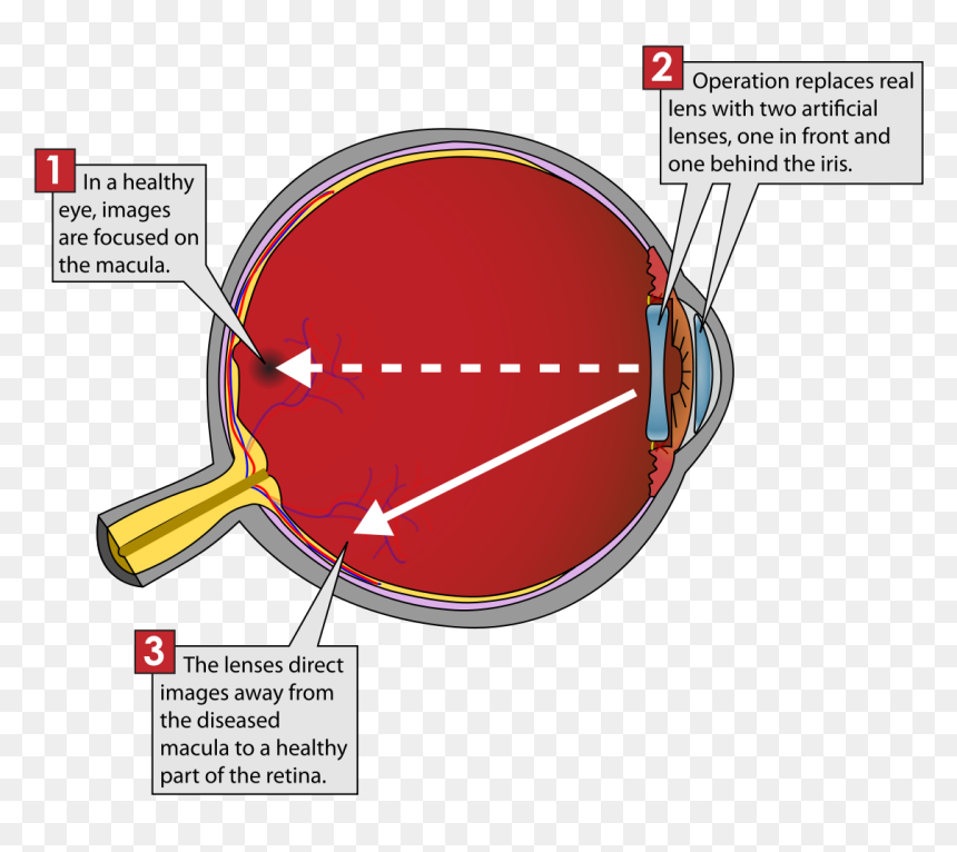 Implantable Miniature Telescope Diagram, HD Png Download - red eye lens png