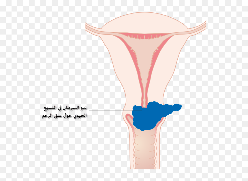 Diagram Showing Stage 2b Cervical Cancer Cruk 216-ar - Cervical Cancer, HD Png Download - ar png