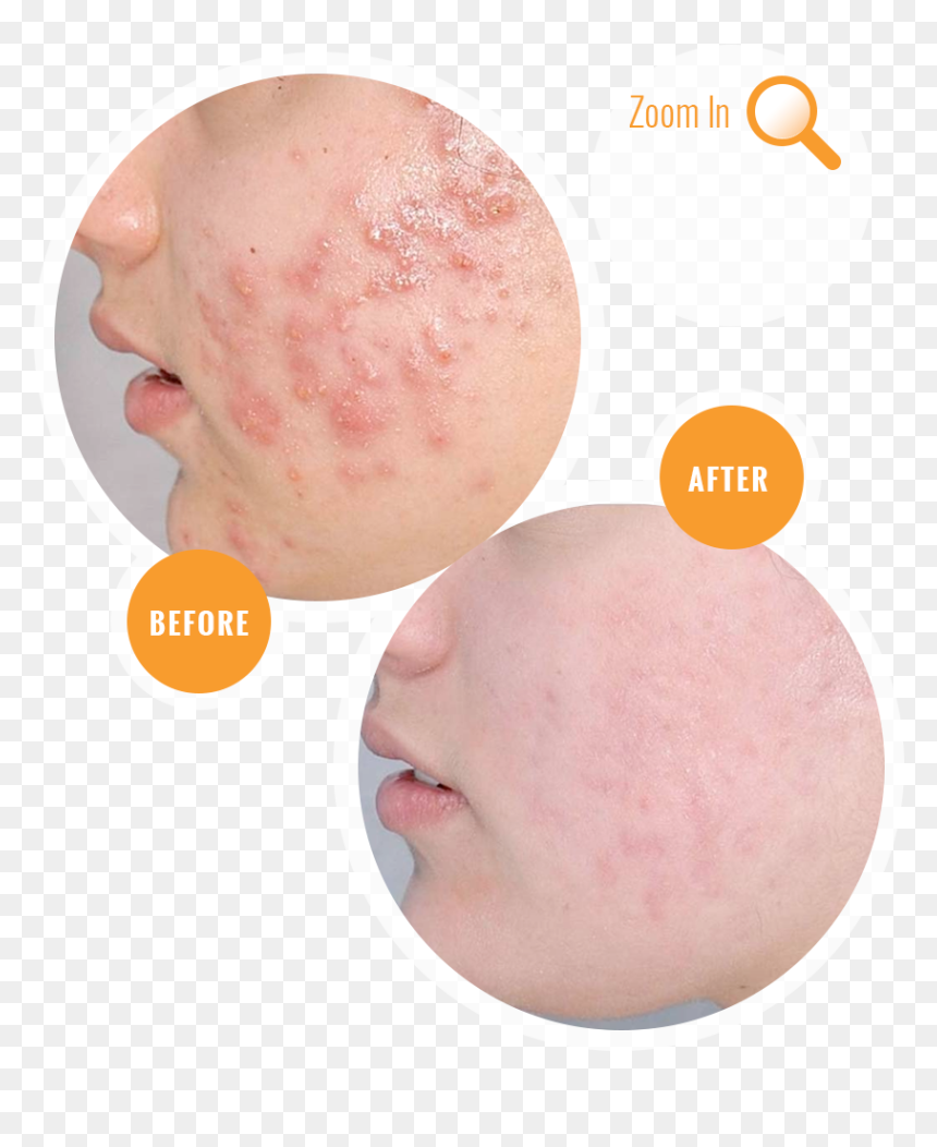 Acne Before And After Treatment - Acne Before And After, HD Png Download - acne png