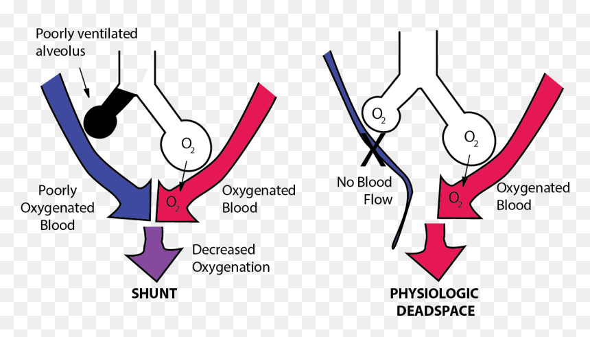Imbalance Between Perfusion And Ventilation Is Called - Pulmonary Shunt, HD Png Download - dead space logo png