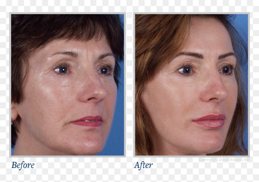 Now Available To The General Public - Skin Texture Before And After, HD Png Download - skin texture png