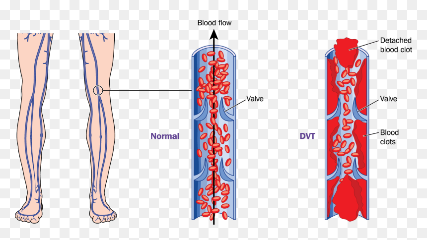 What Is Deep Vein Thrombosis - Deep Vein Thrombosis Diagram, HD Png Download - vein png