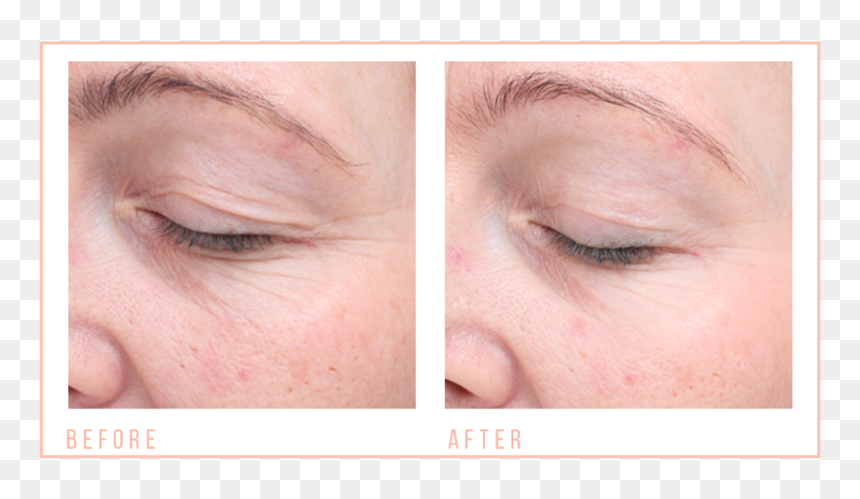 Before & After Hooded Eyes 2 - Collage, HD Png Download - wrinkles png