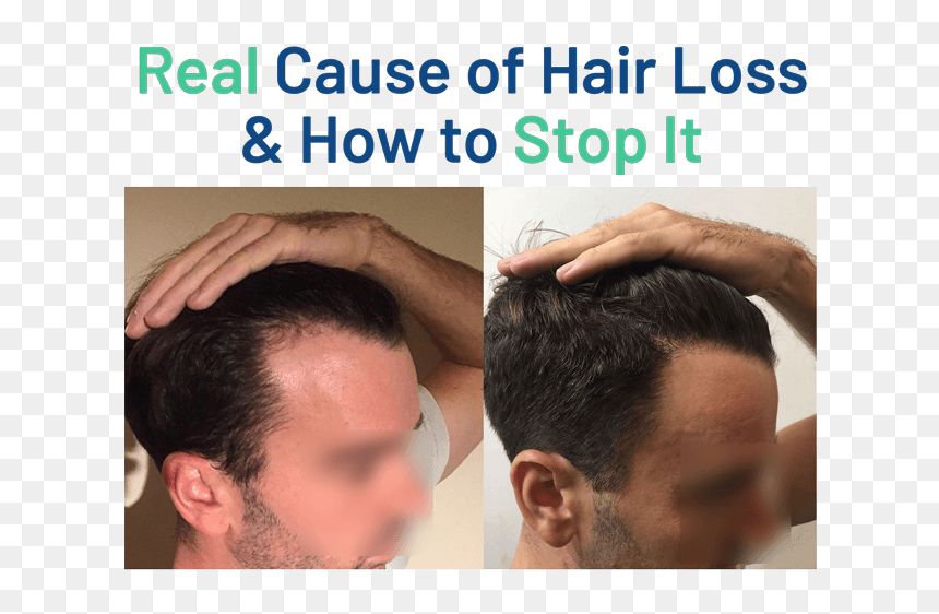 Growband Before And After, HD Png Download - hair strand png