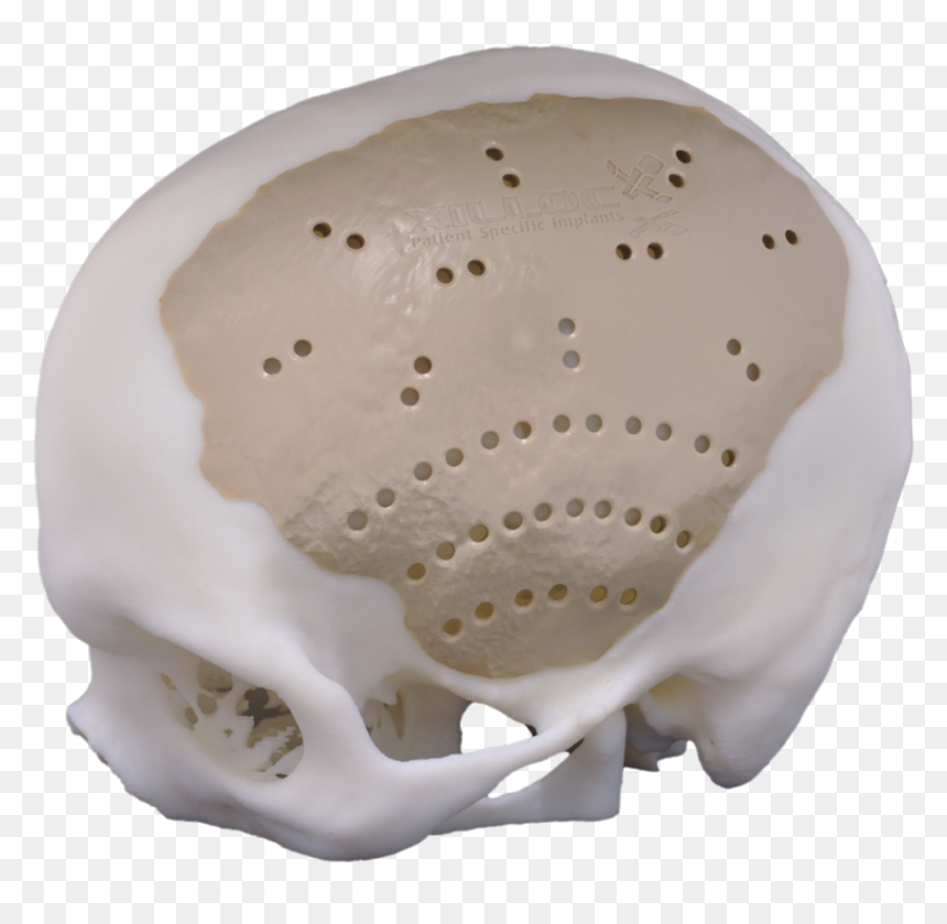 Peek Cranial Implant, HD Png Download - chrome skull png