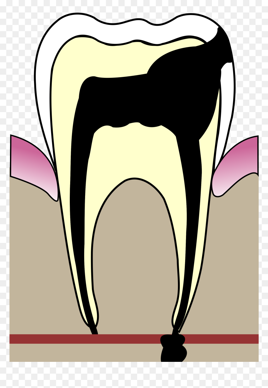 Ears Clipart Hygiene - Апикальный Периодонтит, HD Png Download - elf ear png