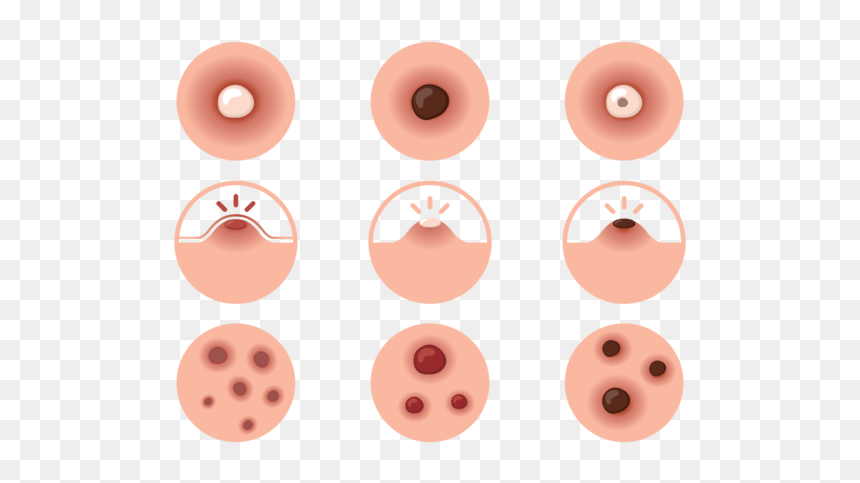 Thumb Image - Pimple Png, Transparent Png - pimple png