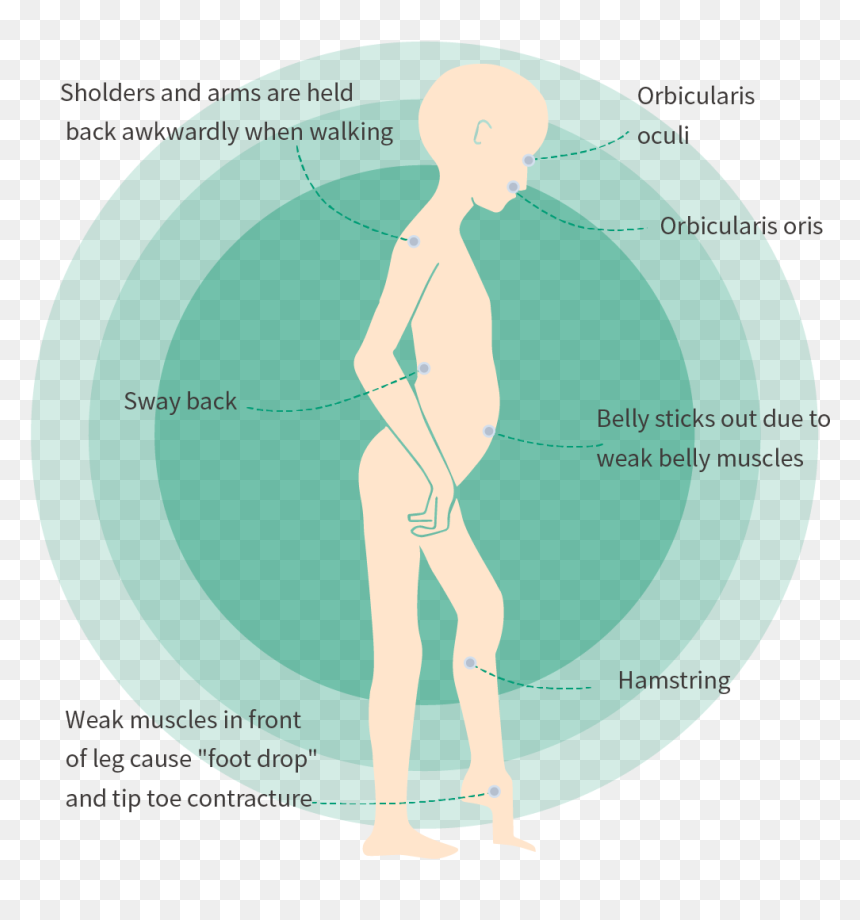 Foot Drop Fshd, HD Png Download - muscle arms png