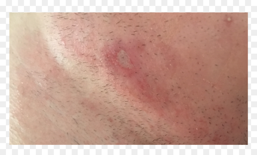 Scar, HD Png Download - pimple png
