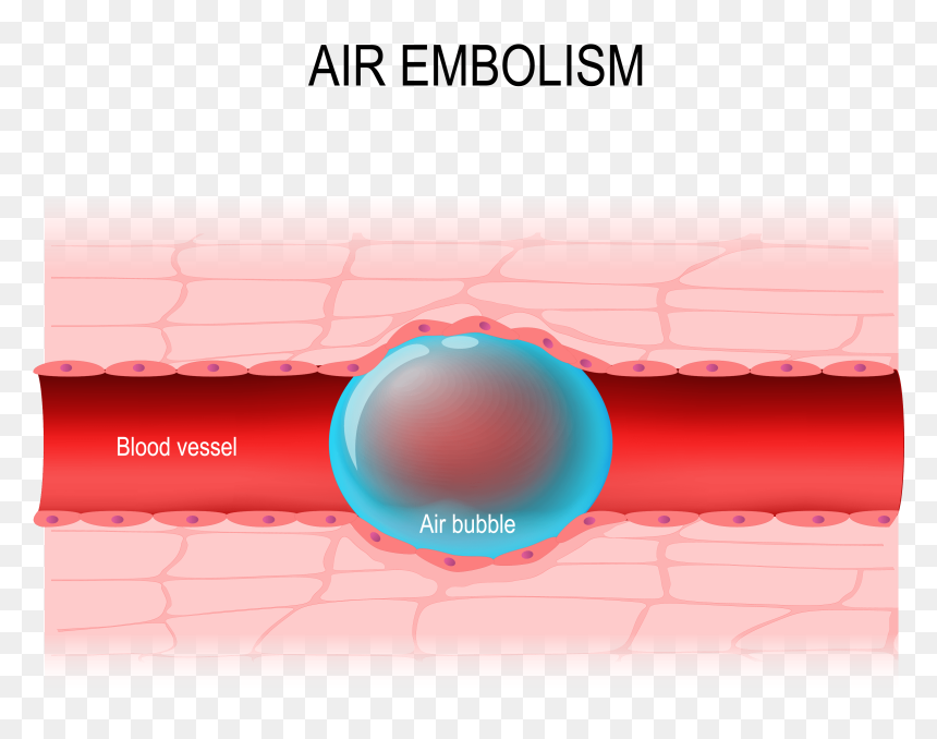 Air Embolisms, HD Png Download - air bubbles png
