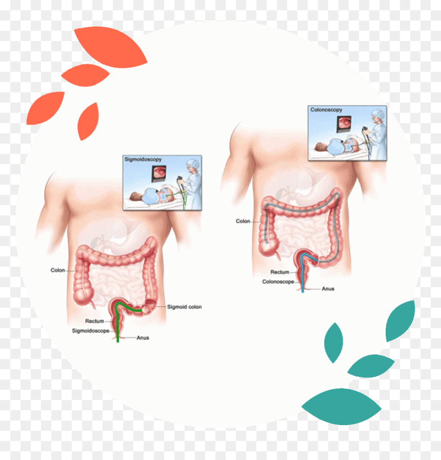 Screening For Colon Disease Surgery In Delhi Noida - Colon Cancer, HD Png Download - colon png