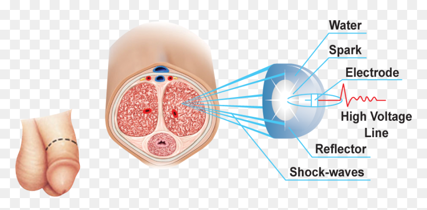 Canadian Pharmacy Survey Of The Latest Viagra Alternative - Erectile Shock, HD Png Download - shockwave effect png