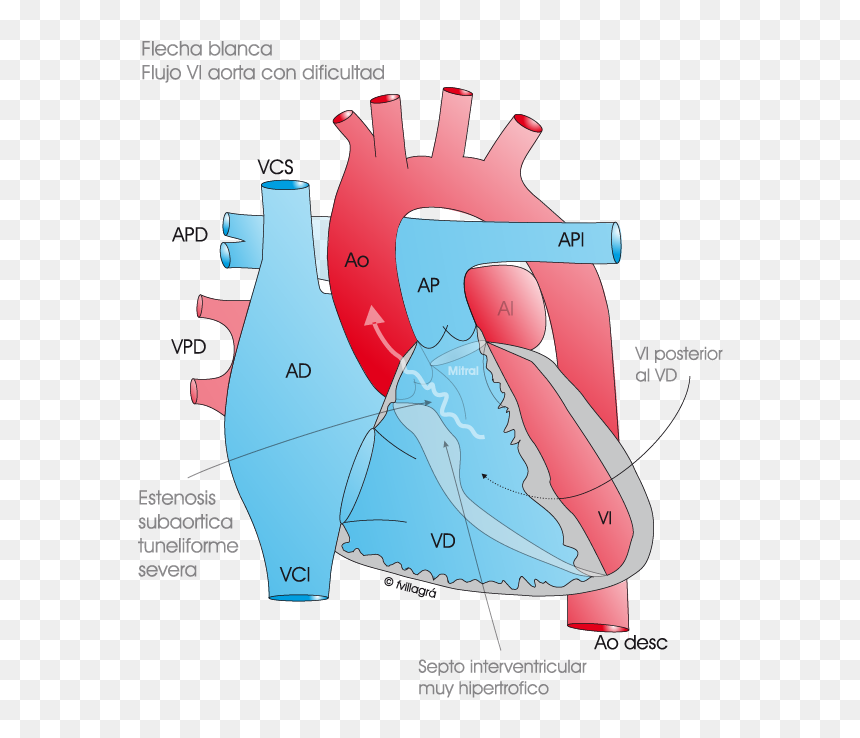 La Estenosis Subaórtica Fibromuscular - Interrupcion Del Arco Aortico, HD Png Download - flecha blanca png