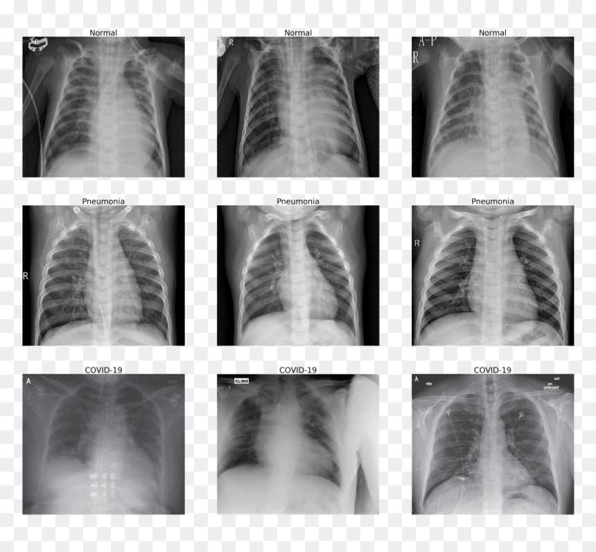 Normal Chest X Ray Vs Covid 19 Chest X Ray, HD Png Download - xray png