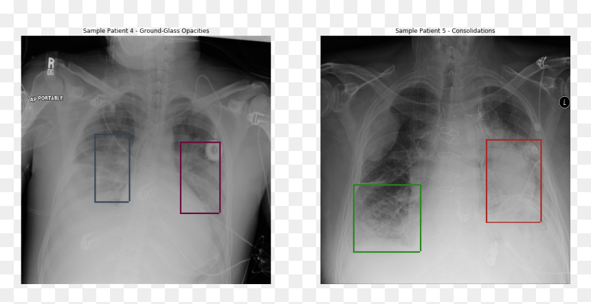 Detecting Pneumonia In X Ray, HD Png Download - xray png