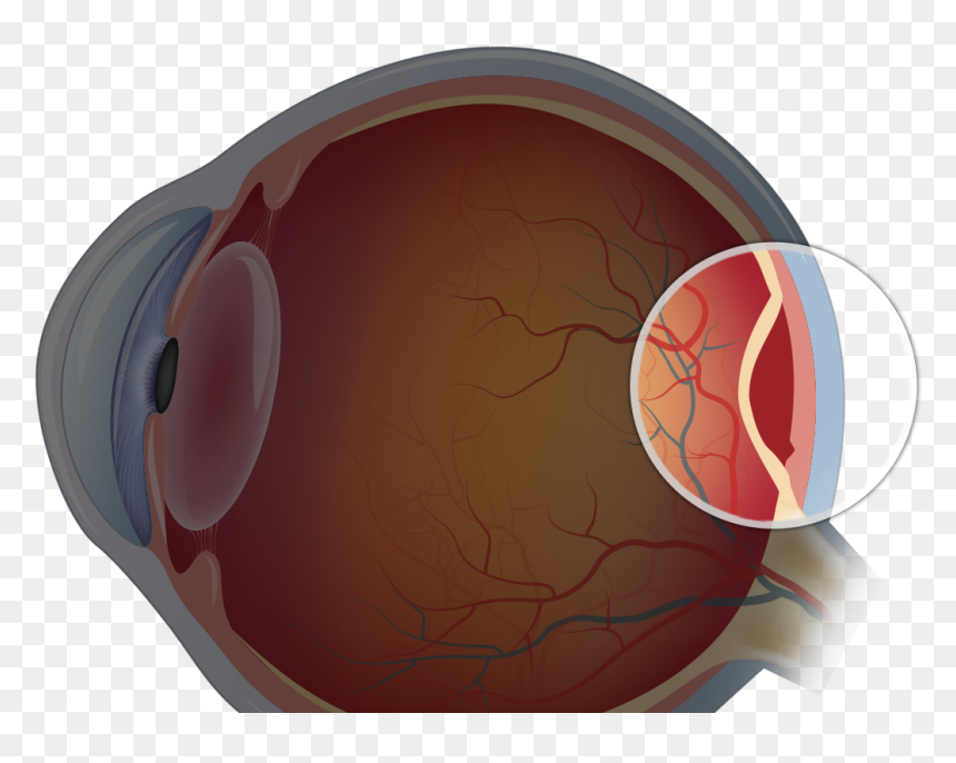 Retinal Detachment - Circle, HD Png Download - blood tears png