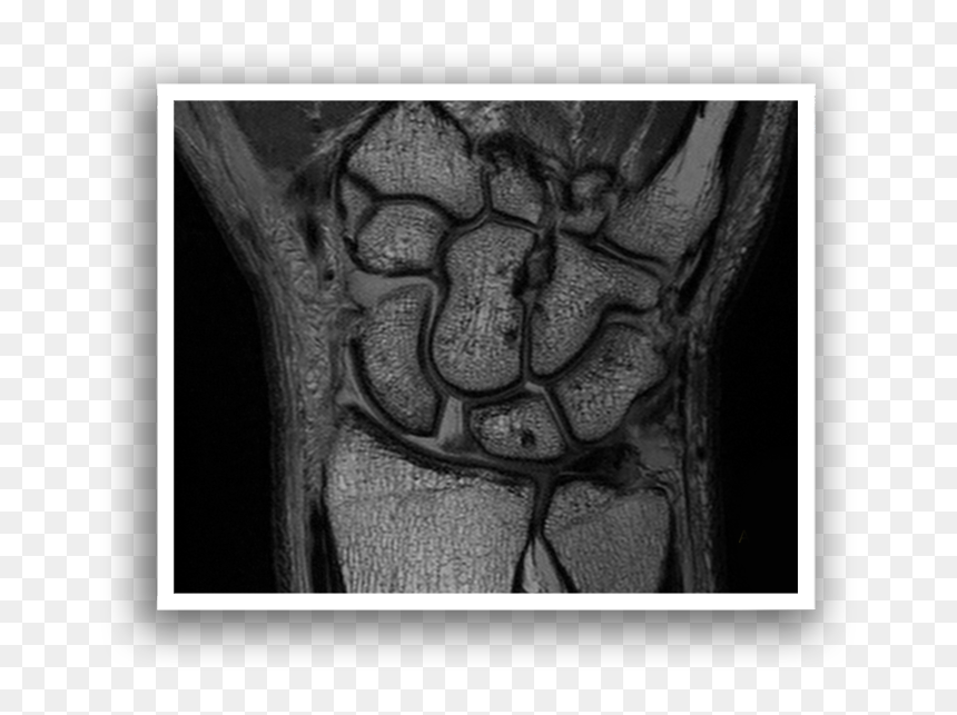 Bone, HD Png Download - xray png