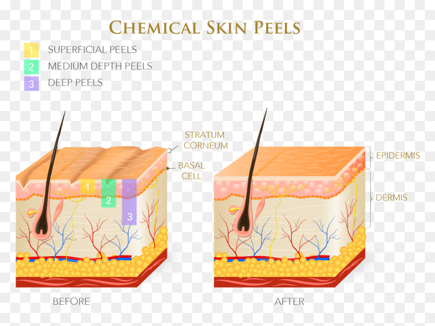 Infographic On Chemical Skin Peels - Layers Of Skin Chemical Peel, HD Png Download - scar texture png
