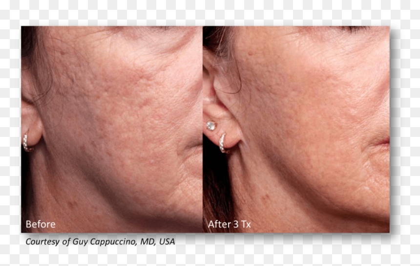 Genius Microneedling Acne Scars, HD Png Download - scar texture png
