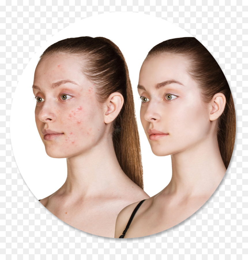 Picking Pimples Makes It Worse, HD Png Download - scar texture png
