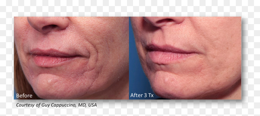 Microneedling Rf Before After Infini, HD Png Download - scar texture png
