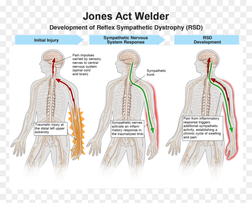 Our Client, A Welder, Spent His Life Working Hard - Welding Neck Pain, HD Png Download - nerves png