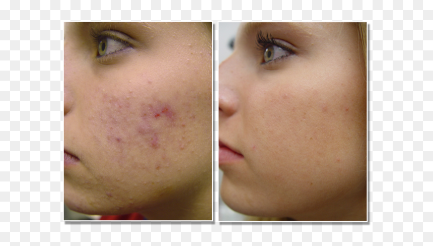 Acne Scarring - Does Acne Look Like At The Start, HD Png Download - face scar png