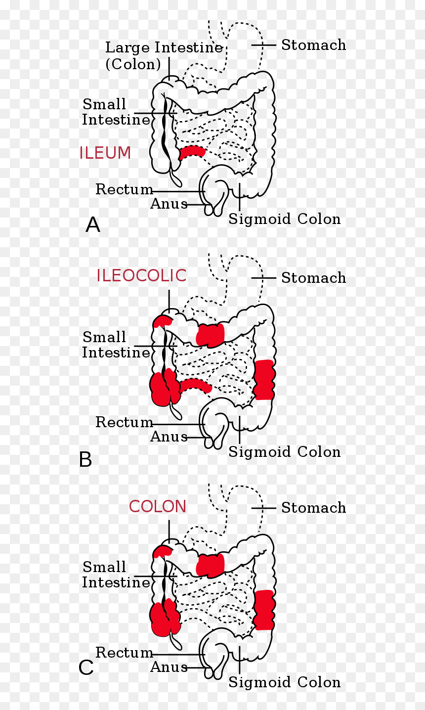 Crohn's Disease 中文, HD Png Download - small intestine png